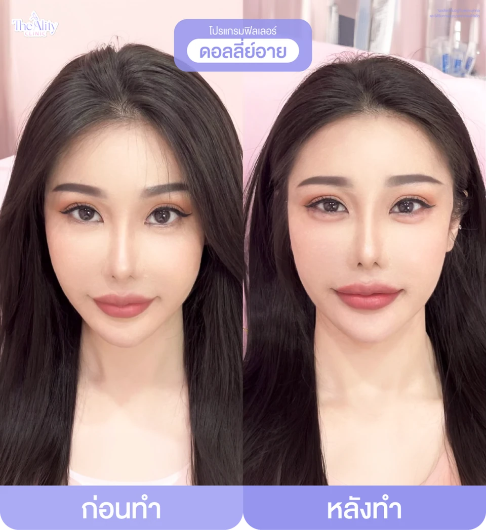 ภาพตัวอย่างก่อนทำและหลังทำโปรแกรมฟิลเลอร์ดอลลี่ย์อายจากคลินิก
