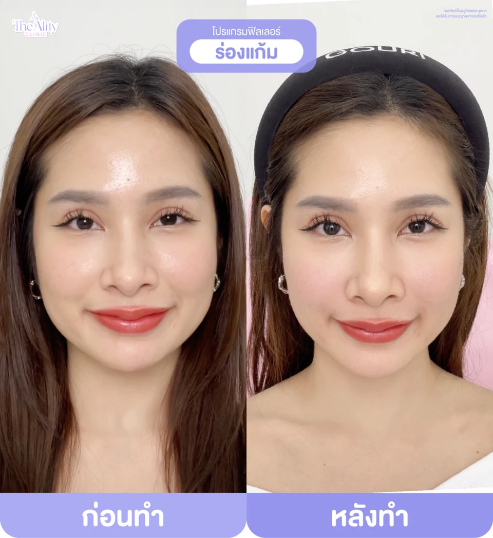 ภาพตัวอย่างก่อนทำและหลังทำโปรแกรมฟิลเลอร์ร่องแก้มจากคลินิก