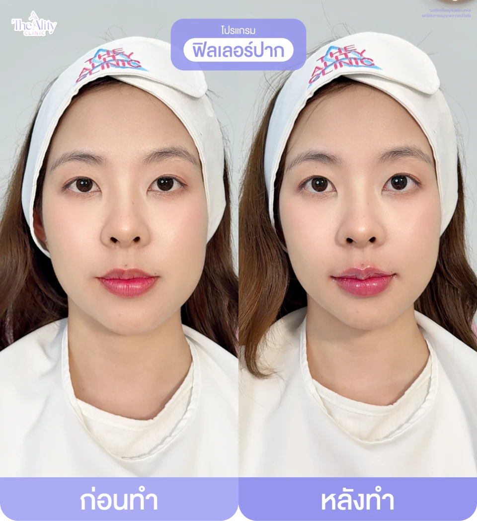 ภาพรีวิว ฟิลเลอร์ปาก ที่คลินิกจัดส่ง