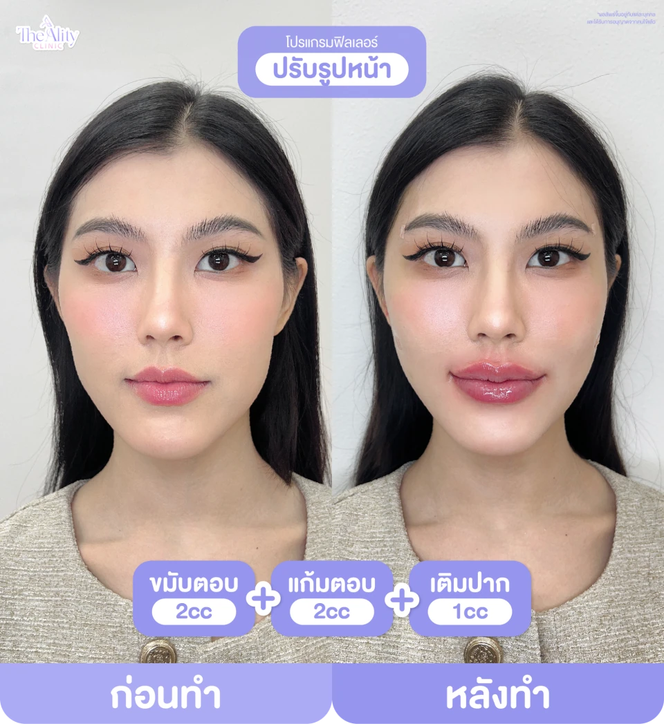 ภาพรีวิว ฟิลเลอร์ปรับรูปหน้า ที่คลินิกจัดส่ง
