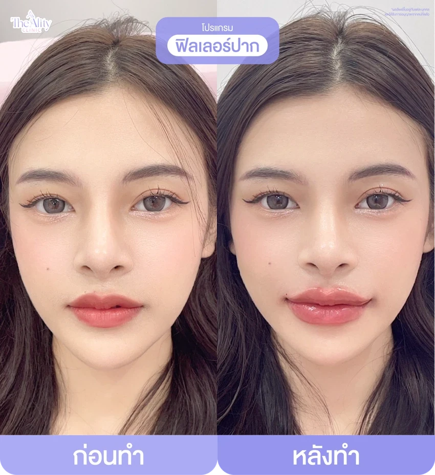รีวิวโปรแกรมฟิลเลอร์ปาก ก่อนทำและหลังทำ 10