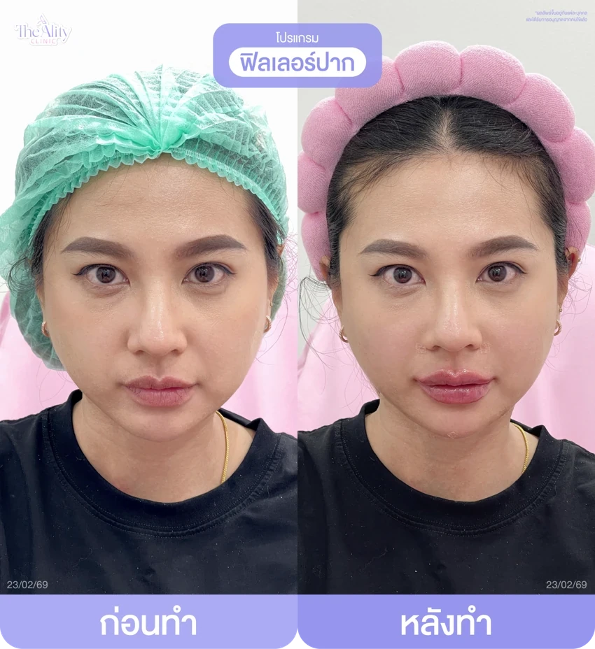 รีวิวโปรแกรมฟิลเลอร์ปาก ก่อนทำและหลังทำ 11