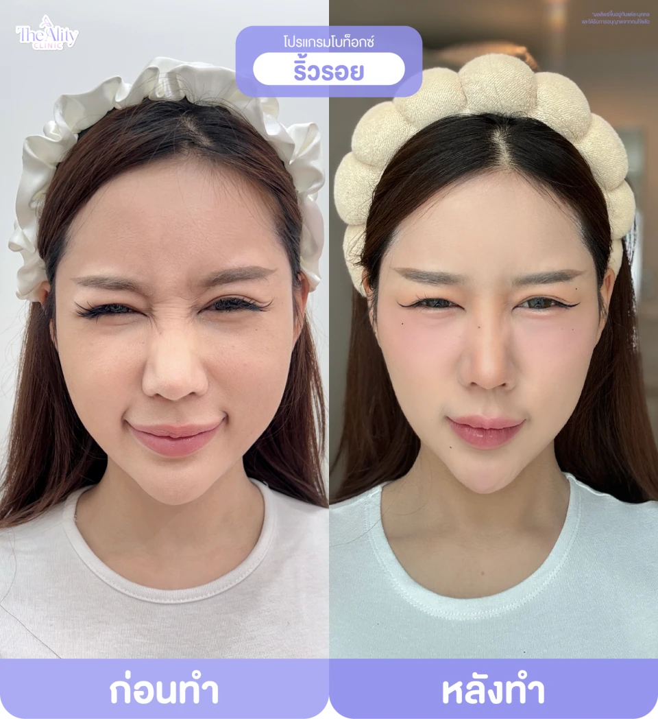 ภาพรีวิว โบท็อกซ์ริ้วรอย ที่คลินิกจัดส่ง