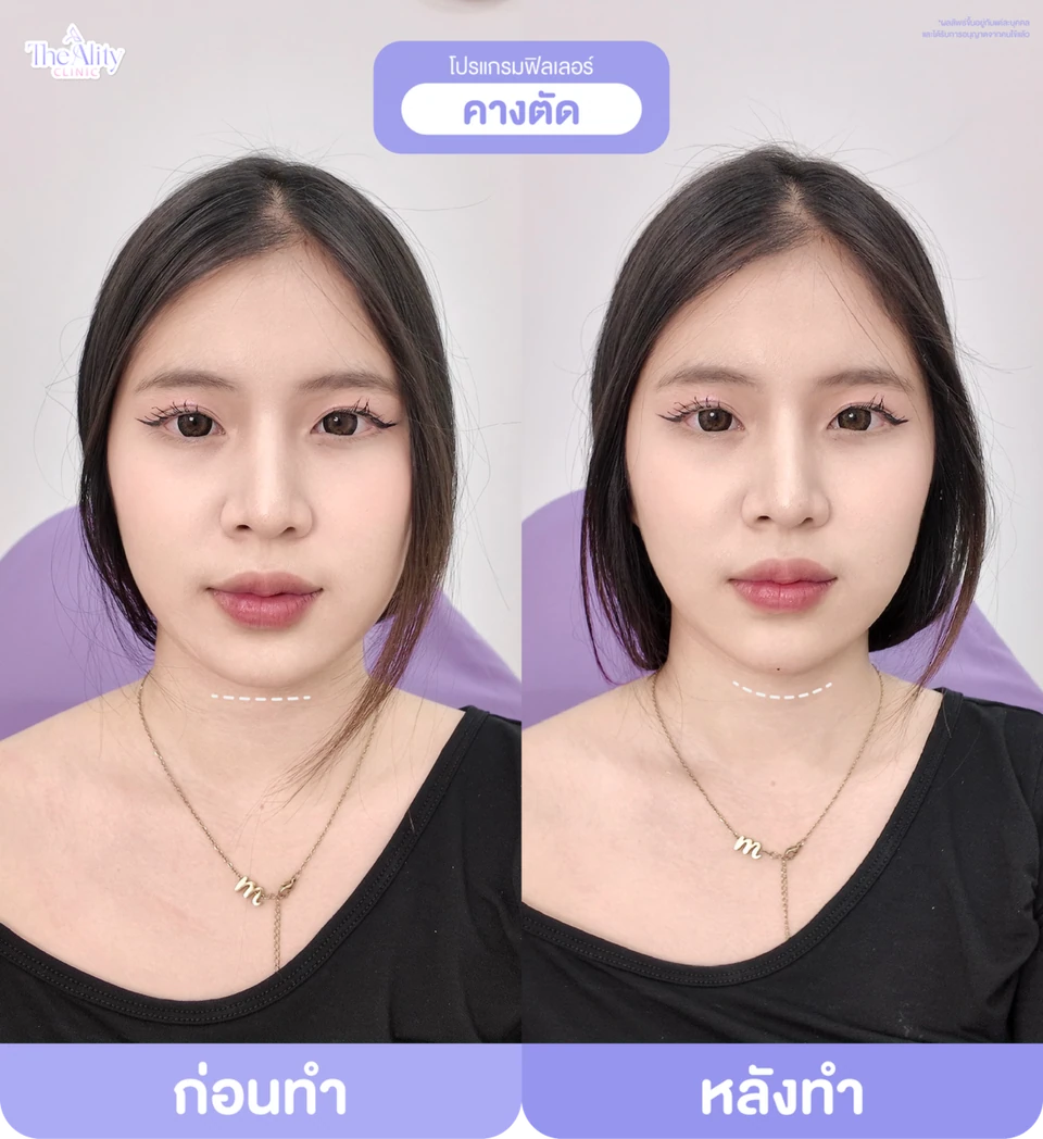 ภาพตัวอย่างก่อนทำและหลังทำโปรแกรมฟิลเลอร์คางจากคลินิก