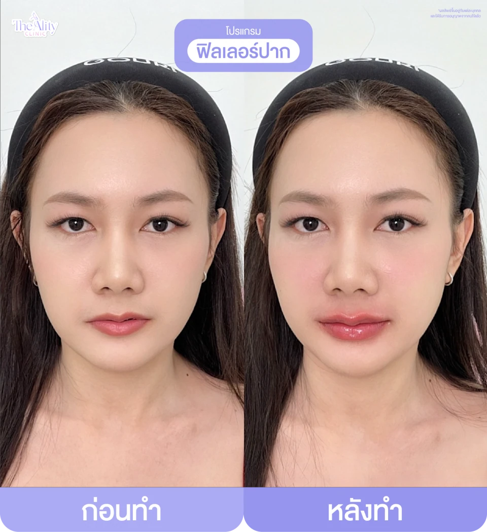 ภาพรีวิว ฟิลเลอร์ปาก ที่คลินิกจัดส่ง