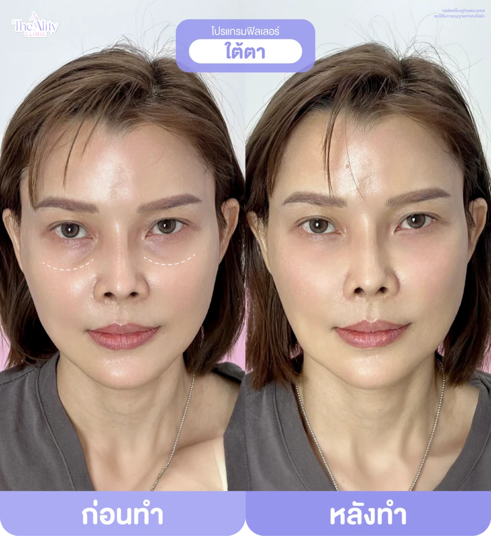 ภาพตัวอย่างก่อนทำและหลังทำโปรแกรมฟิลเลอร์ใต้ตาจากคลินิก