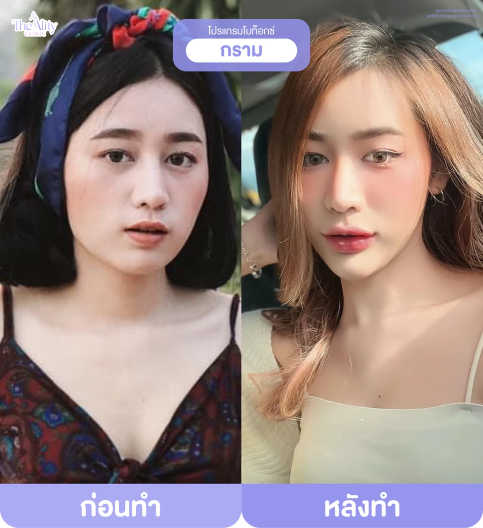 ภาพตัวอย่างก่อนทำและหลังทำโปรแกรมโบท็อกซ์กรามจากคลินิก