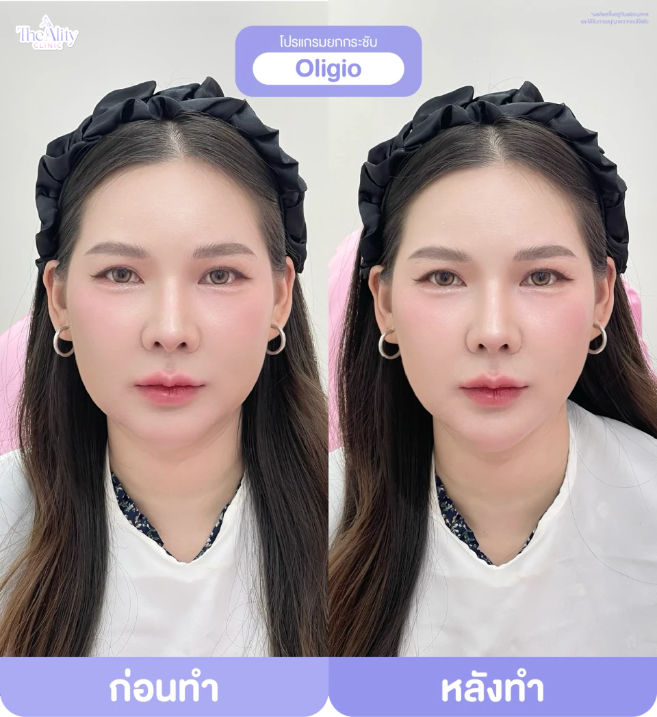 ภาพรีวิว Oligio ที่คลินิกจัดส่ง