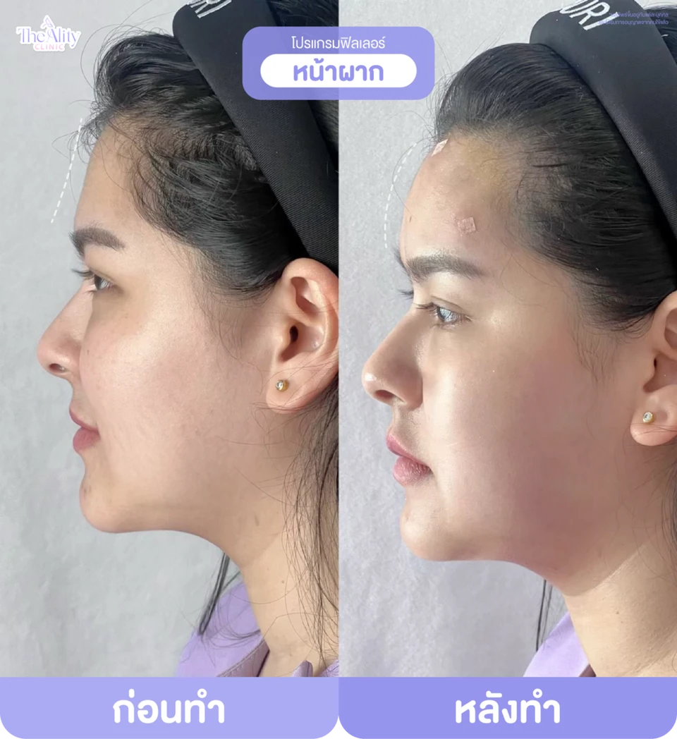 ภาพตัวอย่างก่อนทำและหลังทำโปรแกรมฟิลเลอร์หน้าผากจากคลินิก