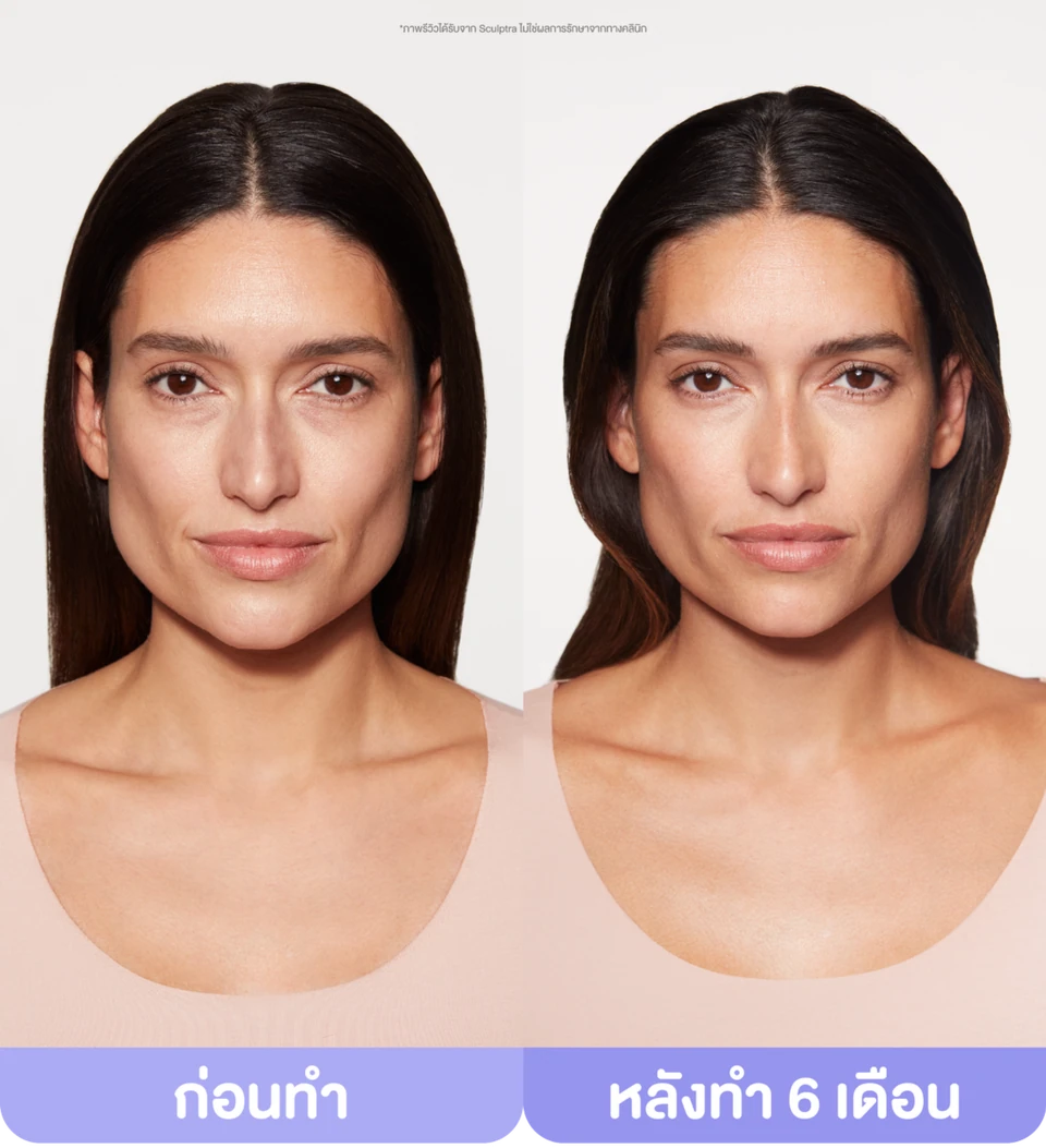 ภาพรีวิว Sculptra ก่อนทำและหลังทำ 6 เดือน ซึ่งได้รับจาก Sculptra