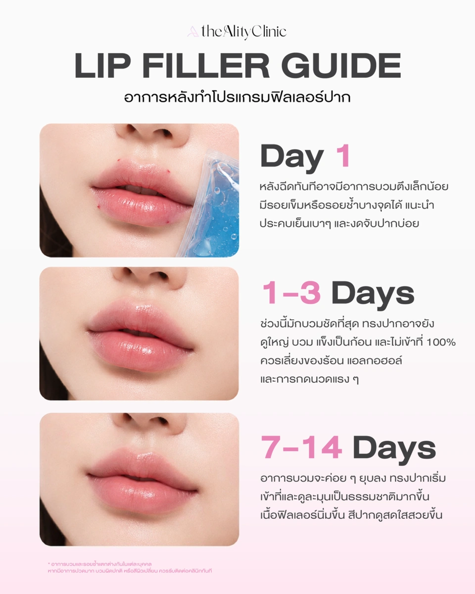 ภาพประกอบอาการหลังฉีดฟิลเลอร์ปาก Day 1 ถึง 7–14 Days