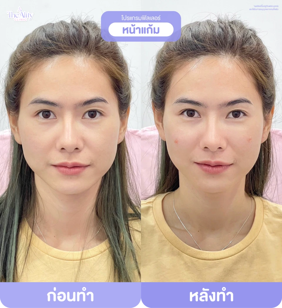 ภาพตัวอย่างก่อนทำและหลังทำโปรแกรมฟิลเลอร์หน้าแก้มจากคลินิก