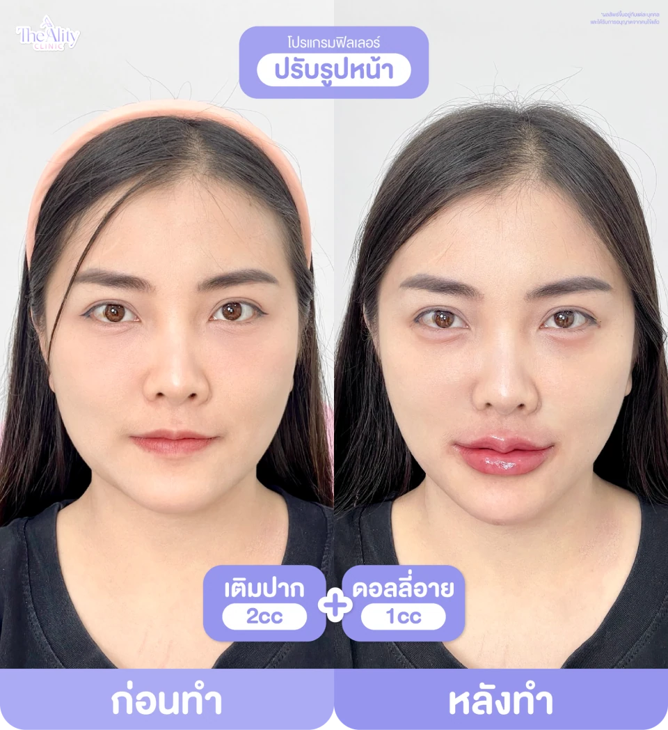 ภาพรีวิว ฟิลเลอร์ปรับรูปหน้า ที่คลินิกจัดส่ง