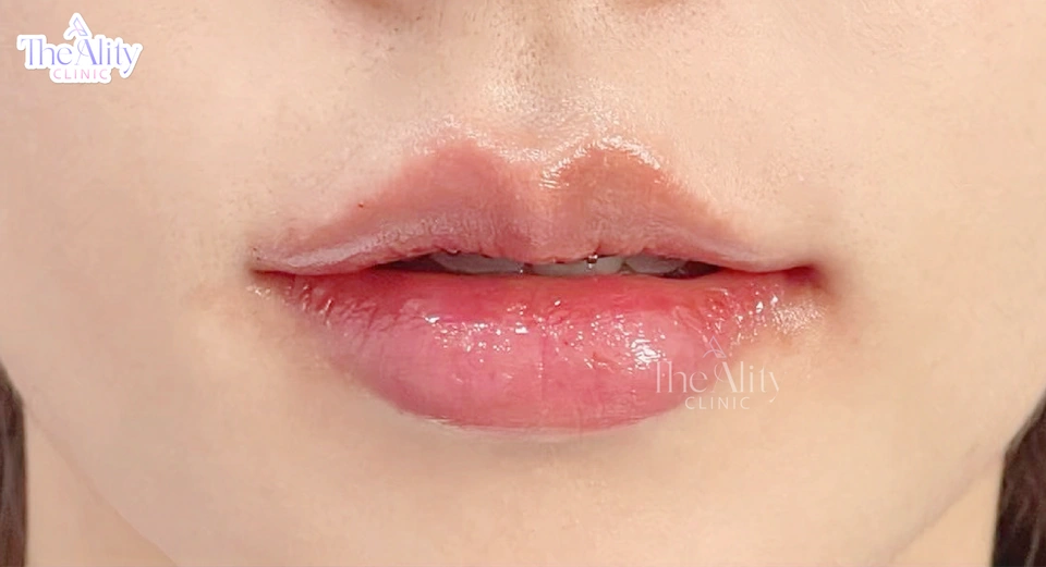 ภาพตัวอย่างทรง Defined Lips ของ The Ality Clinic
