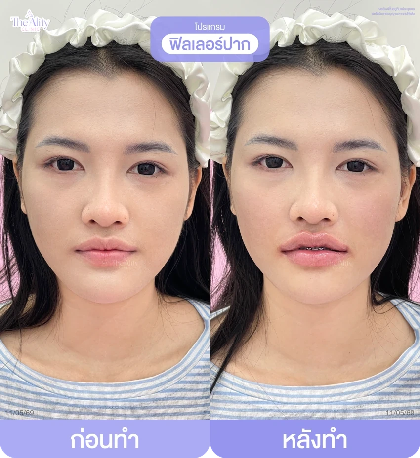 รีวิวโปรแกรมฟิลเลอร์ปาก ก่อนทำและหลังทำ 12