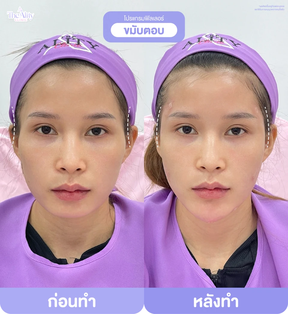 ภาพตัวอย่างก่อนทำและหลังทำโปรแกรมฟิลเลอร์ขมับจากคลินิก