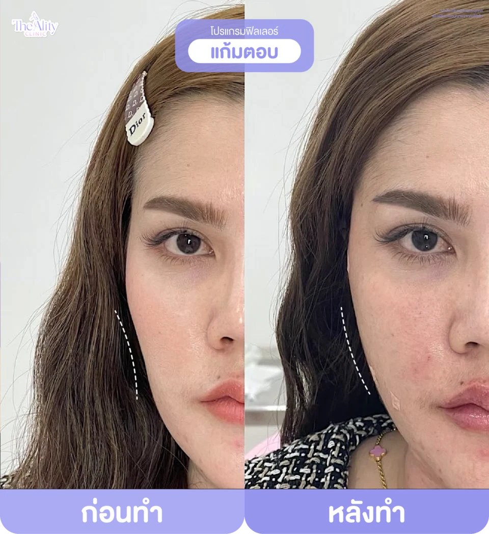 ภาพตัวอย่างก่อนทำและหลังทำโปรแกรมฟิลเลอร์แก้มตอบจากคลินิก