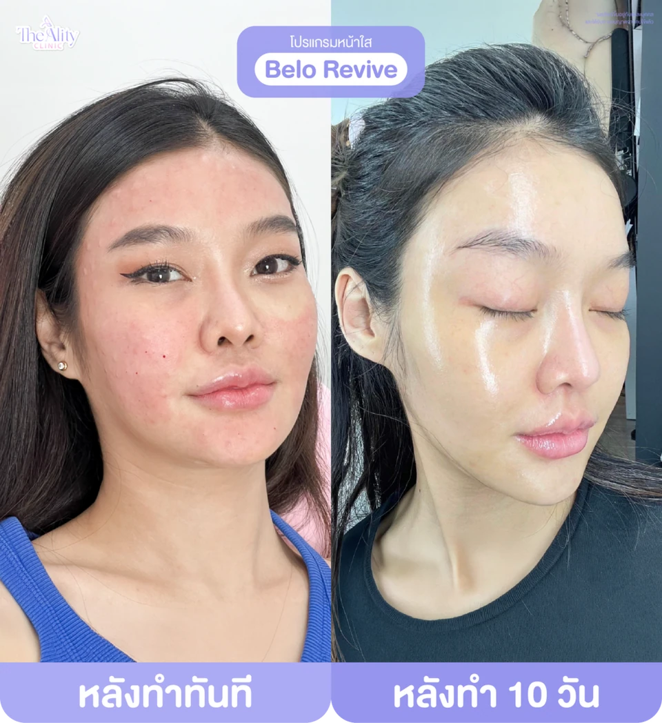 ภาพรีวิวโปรแกรม Belo Revive หลังทำทันทีและหลังทำ 10 วัน จาก The Ality Clinic
