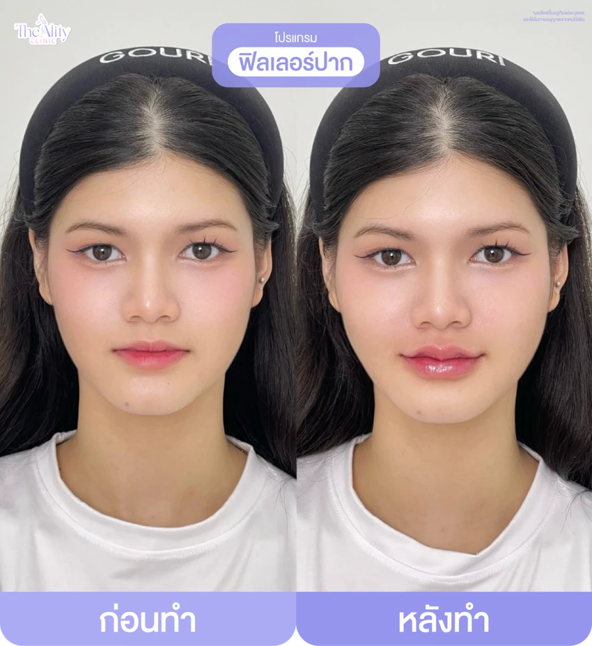 รีวิวโปรแกรมฟิลเลอร์ปาก ก่อนทำและหลังทำ 1