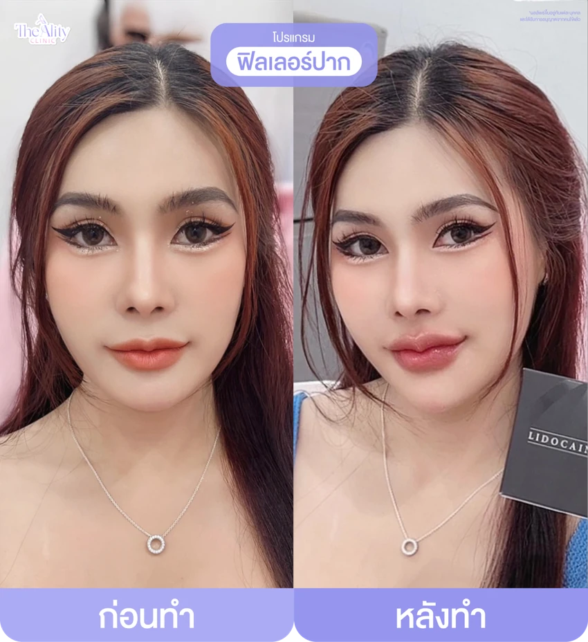 รีวิวโปรแกรมฟิลเลอร์ปาก ก่อนทำและหลังทำ 3