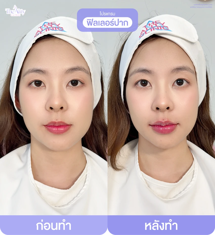 รีวิวโปรแกรมฟิลเลอร์ปาก ก่อนทำและหลังทำ 4