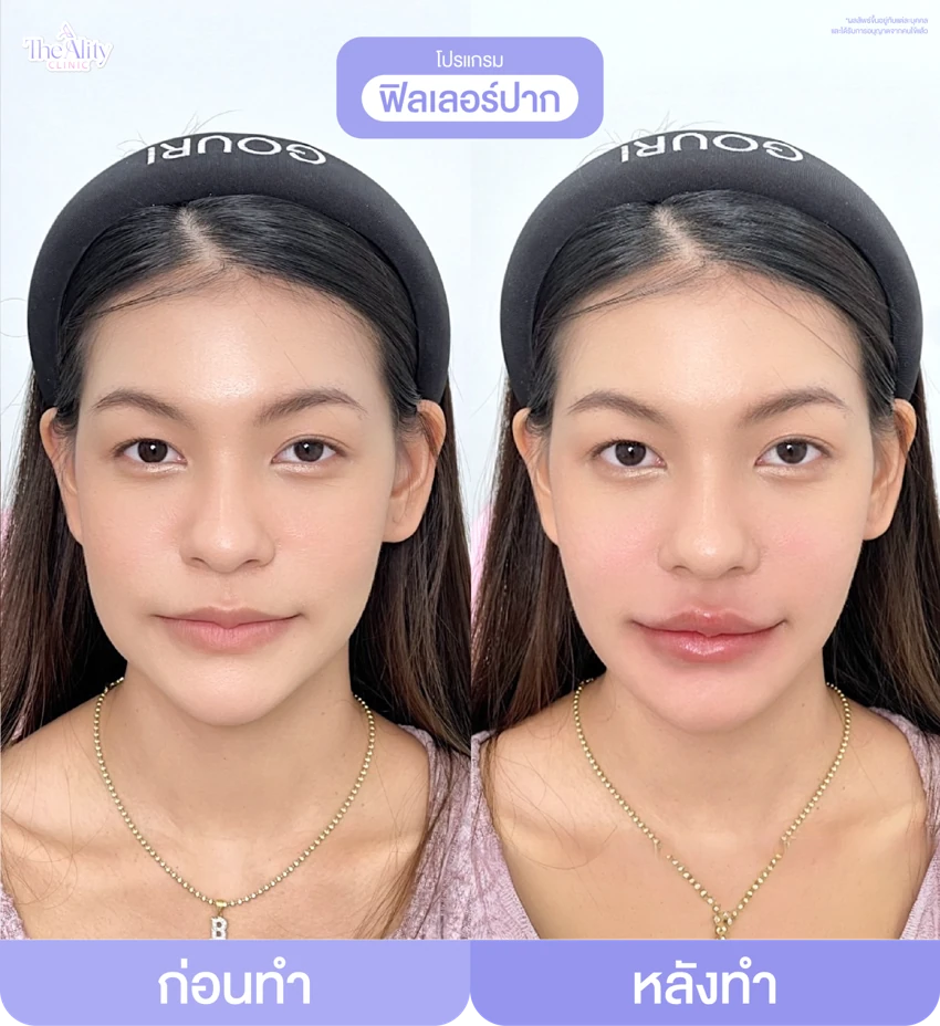 รีวิวโปรแกรมฟิลเลอร์ปาก ก่อนทำและหลังทำ 5