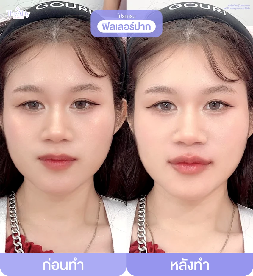 รีวิวโปรแกรมฟิลเลอร์ปาก ก่อนทำและหลังทำ 6
