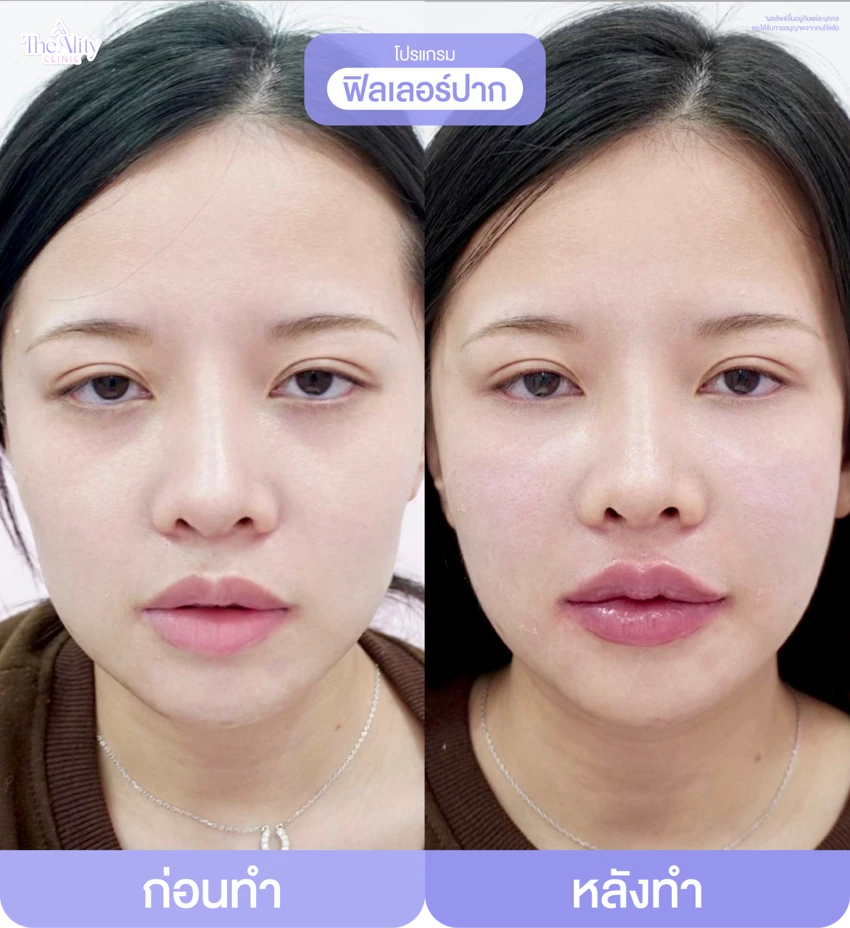 รีวิวโปรแกรมฟิลเลอร์ปาก ก่อนทำและหลังทำ 7