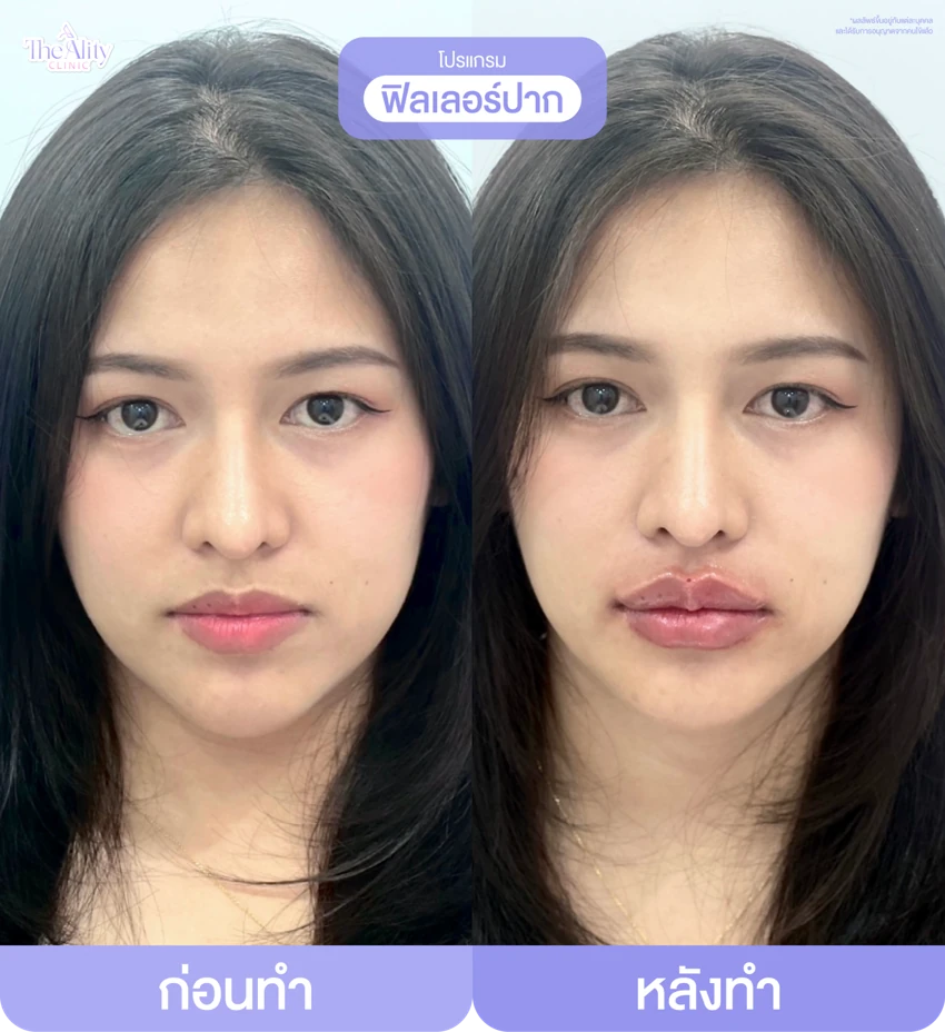 รีวิวโปรแกรมฟิลเลอร์ปาก ก่อนทำและหลังทำ 8
