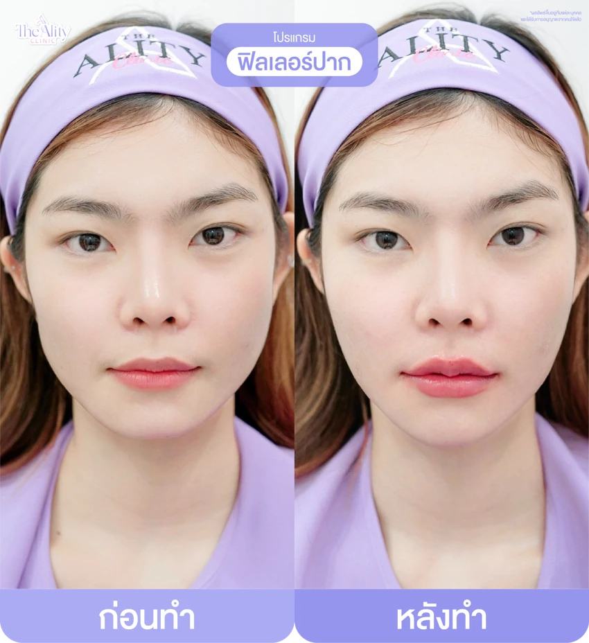 รีวิวโปรแกรมฟิลเลอร์ปาก ก่อนทำและหลังทำ 9