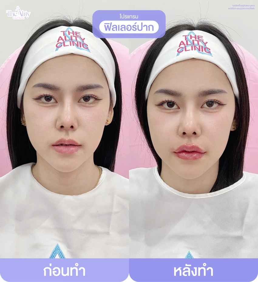 รีวิวโปรแกรมฟิลเลอร์ปาก ก่อนทำและหลังทำ 14