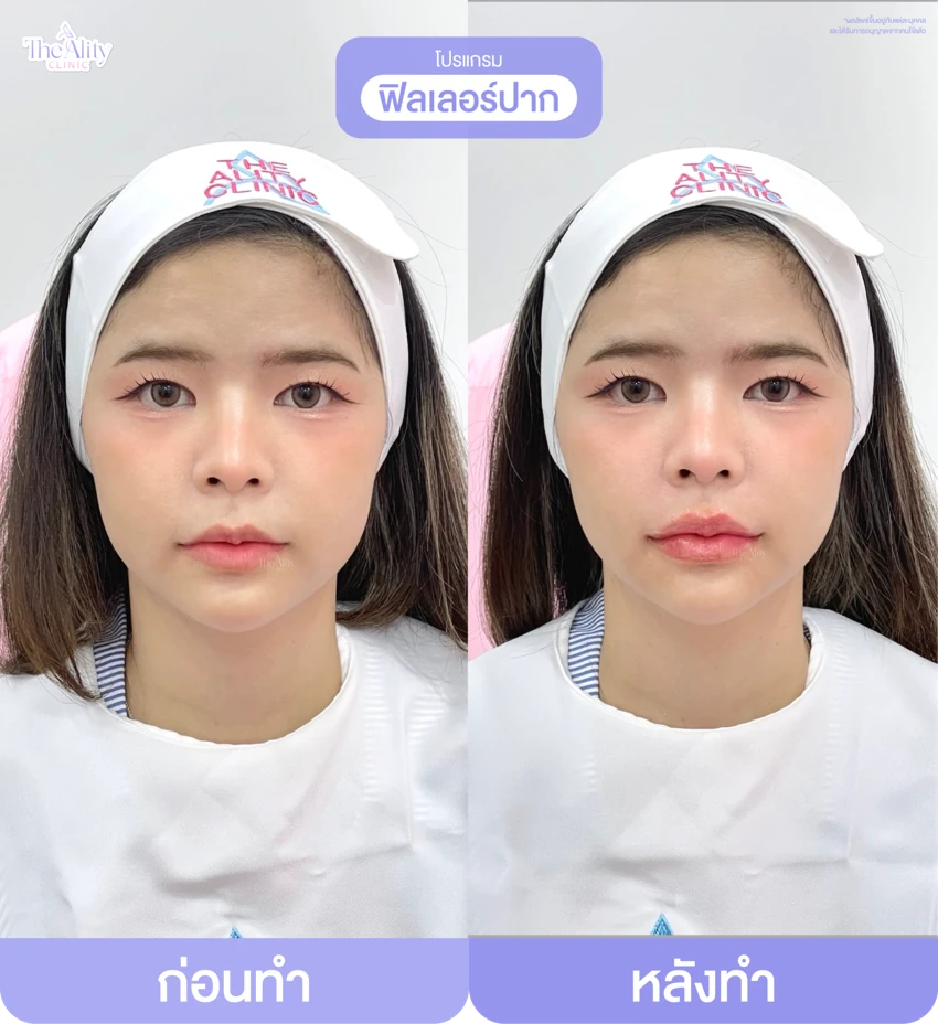 รีวิวโปรแกรมฟิลเลอร์ปาก ก่อนทำและหลังทำ 15